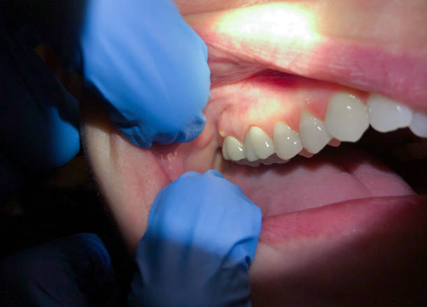 Best Emergency Root Canal Treatment in Lake Linden, MI